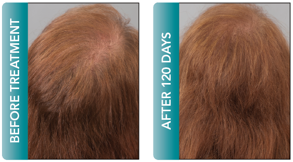 female hair regrowth delray beach