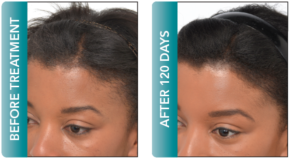 female hair regrowth delray beach