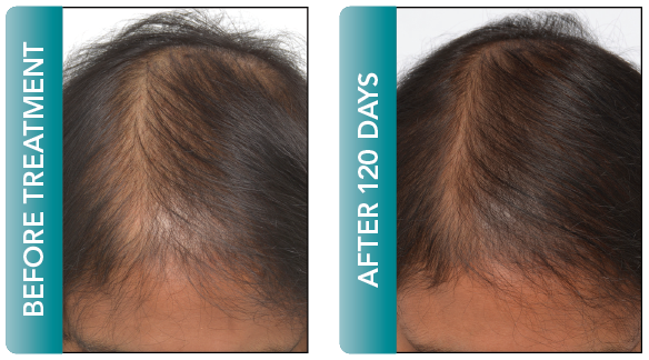 female hair regrowth delray beach