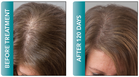 female hair regrowth delray beach