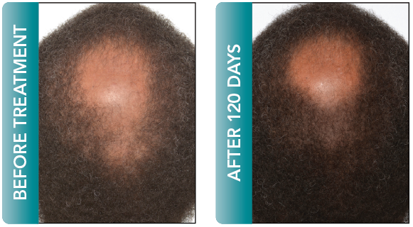 male hair regrowth delray beach