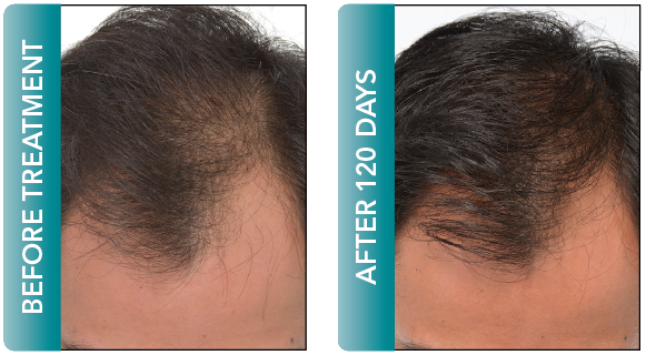 male hair regrowth delray beach