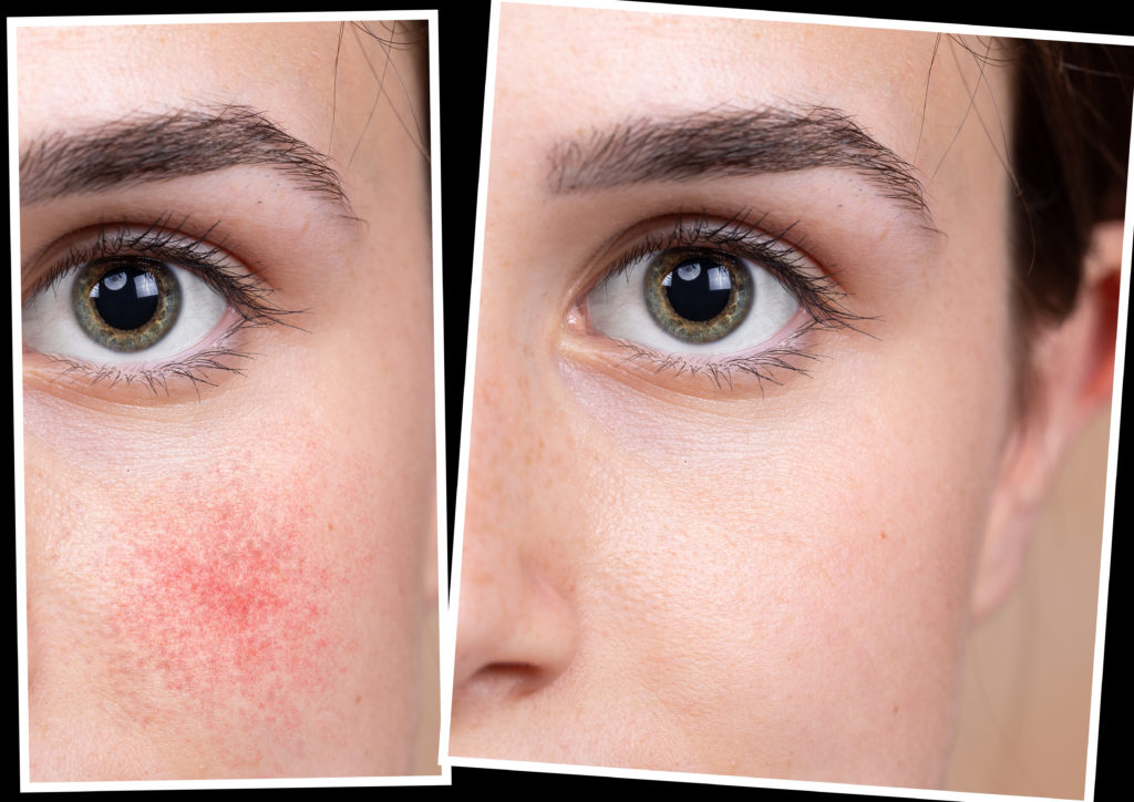 Reducing Rosacea Treatments With Lasers | Balshi Dermatology