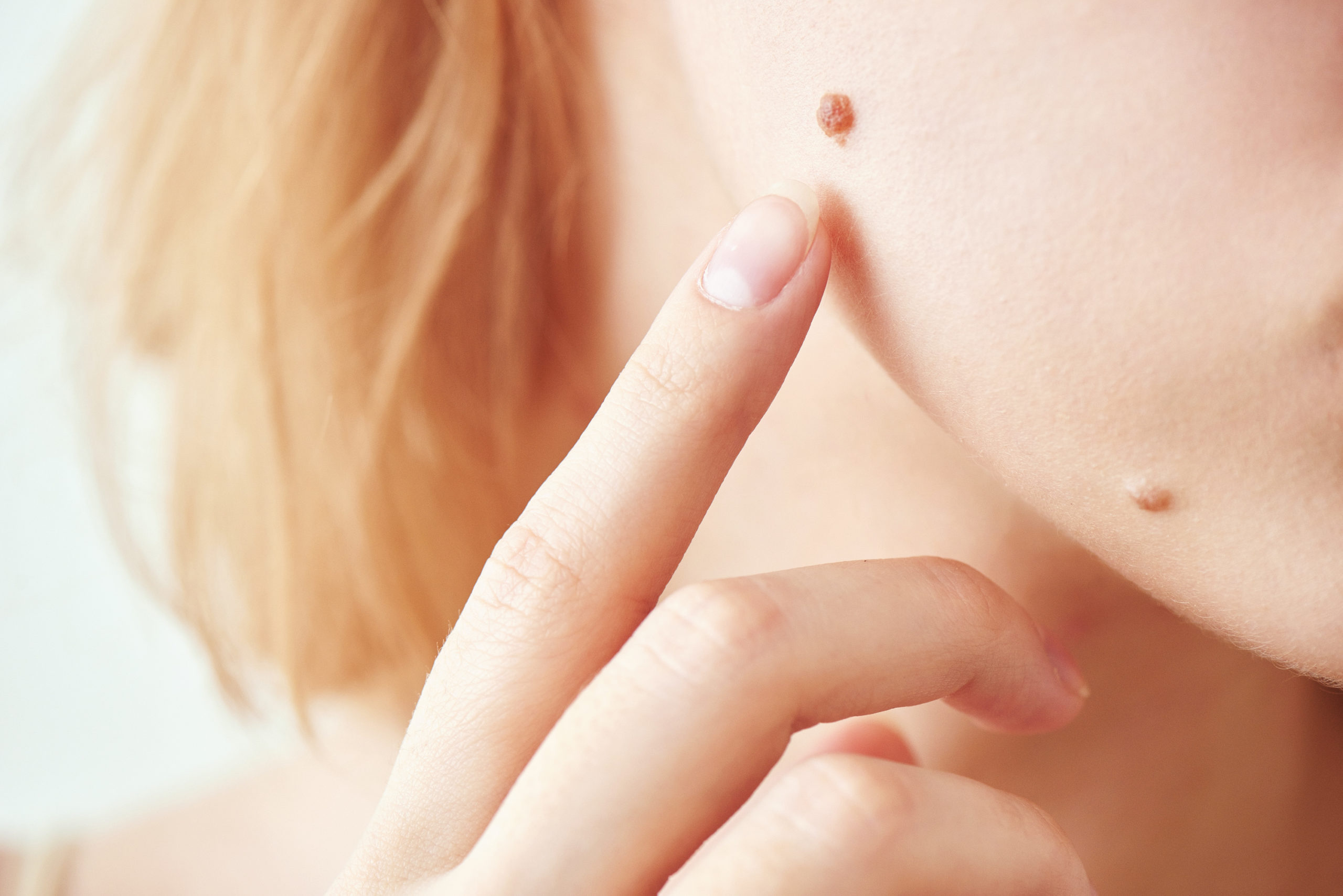 How To Decide When To See Your Dermatologist About A Mole Balshi